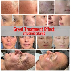 CLETINA Adjustable Microneedling Derma Stamp Pen,Derma Roller Alternative,140 Titanium 0.25 Mm Pins For Face Body Skin Care And Hair Beard Growth